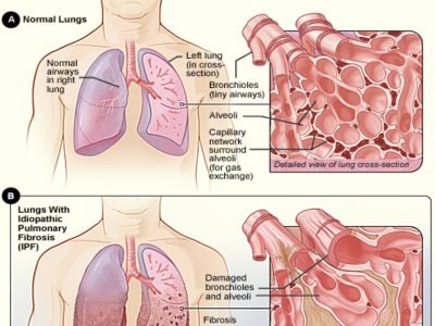 Idiopathic-pulmonary-fibrosis
